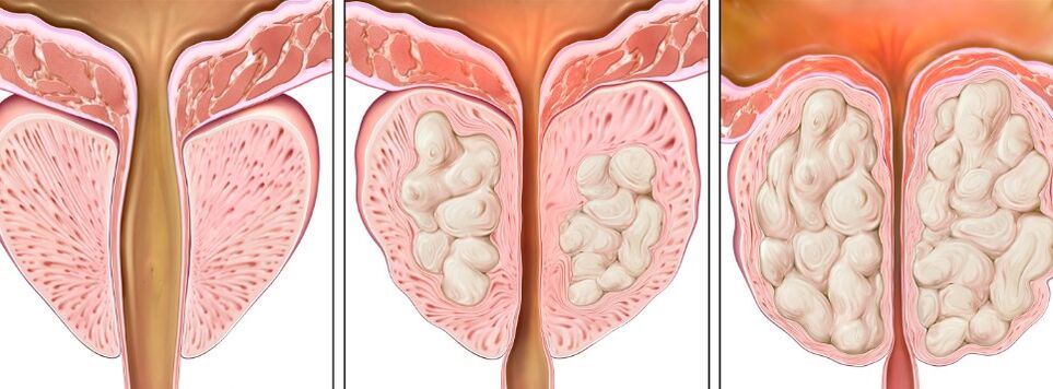 Prostatitisphase